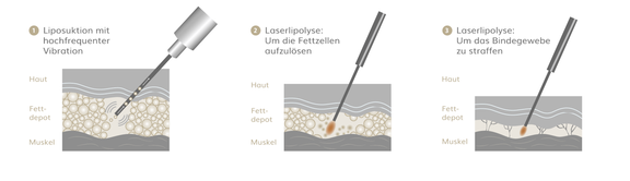 Lipödem OP, Plastische & Ästhetische Chirurgie in Mannheim, Dr. Schumacher