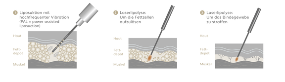 Lipödem OP, Plastische & Ästhetische Chirurgie in Mannheim, Dr. Schumacher
