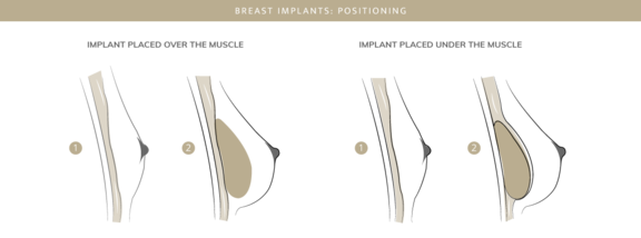 Brustimplantate, Plastische & Ästhetische Chirurgie in Mannheim, Dr. Schumacher