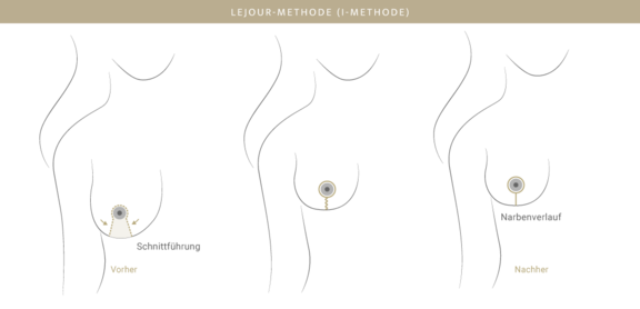 Bruststraffung Lejour-Methode, Plastische & Ästhetische Chirurgie in Mannheim, Dr. Schumacher