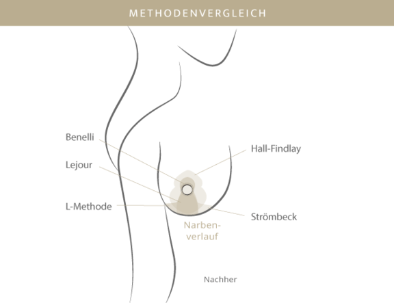 Bruststraffung, Plastische & Ästhetische Chirurgie in Mannheim, Dr. Schumacher