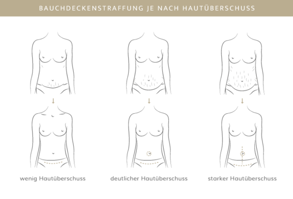 Bauchdeckenstraffung, Plastische & Ästhetische Chirurgie in Mannheim, Dr. Schumacher