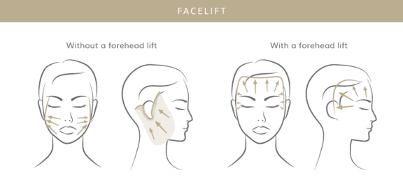 Facelift, Plastische & Ästhetische Chirurgie in Mannheim, Dr. Schumacher