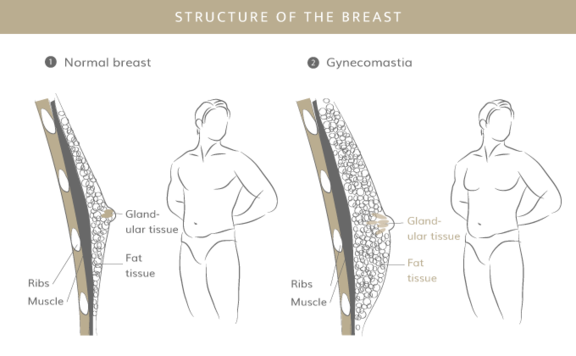 Gynäkomastie, Plastische & Ästhetische Chirurgie in Mannheim, Dr. Schumacher