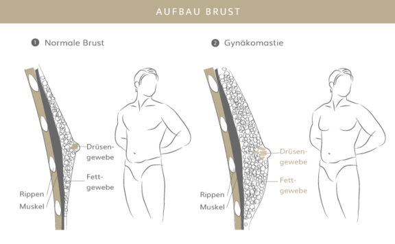 Gynäkomastie, Plastische & Ästhetische Chirurgie in Mannheim, Dr. Schumacher