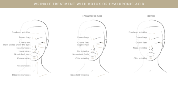 Faltenbehandlung mit Botox oder Hyaluron, Plastische & Ästhetische Chirurgie in Mannheim, Dr. Schumacher