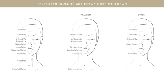 Faltenbehandlung mit Botox oder Hyaluron, Plastische & Ästhetische Chirurgie in Mannheim, Dr. Schumacher
