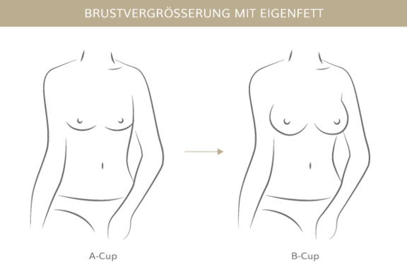 Brustvergrößerung mit Eigenfett, Plastische & Ästhetische Chirurgie in Mannheim, Dr. Schumacher