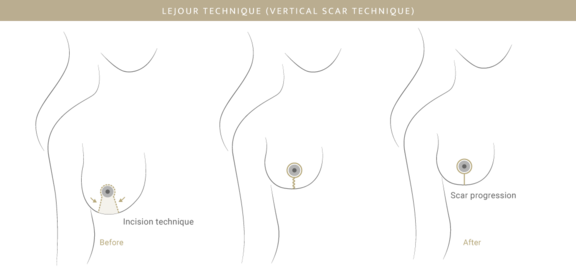 Bruststraffung Lejour-Methode, Plastische & Ästhetische Chirurgie in Mannheim, Dr. Schumacher