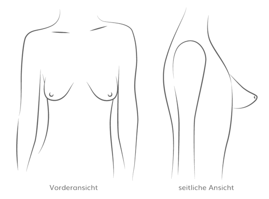 Tubuläre Brust, Plastische & Ästhetische Chirurgie in Mannheim, Dr. Schumacher