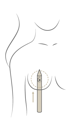 Brustvergrößerung Motiva Preservé™, Plastische & Ästhetische Chirurgie in Mannheim, Dr. Schumacher