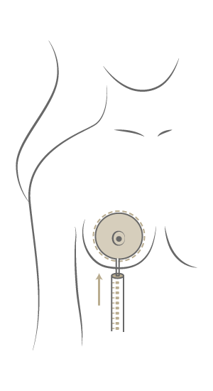 Brustvergrößerung Motiva Preservé™, Plastische & Ästhetische Chirurgie in Mannheim, Dr. Schumacher