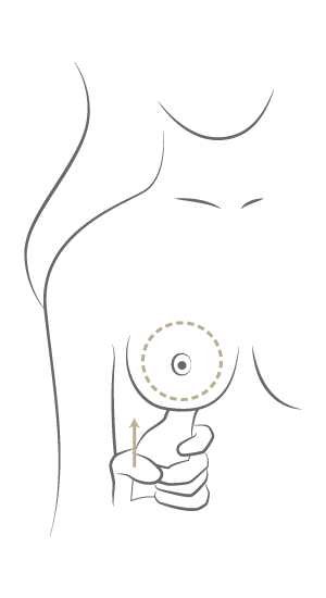 Brustvergrößerung Motiva Preservé™, Plastische & Ästhetische Chirurgie in Mannheim, Dr. Schumacher